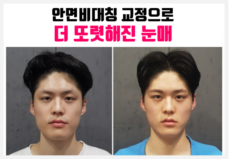 안면비대칭교정운동(눈이 커지는 방법)