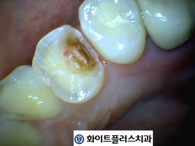 인레이 치료가 필요한 치아 사이 충치 (신풍역 치과)