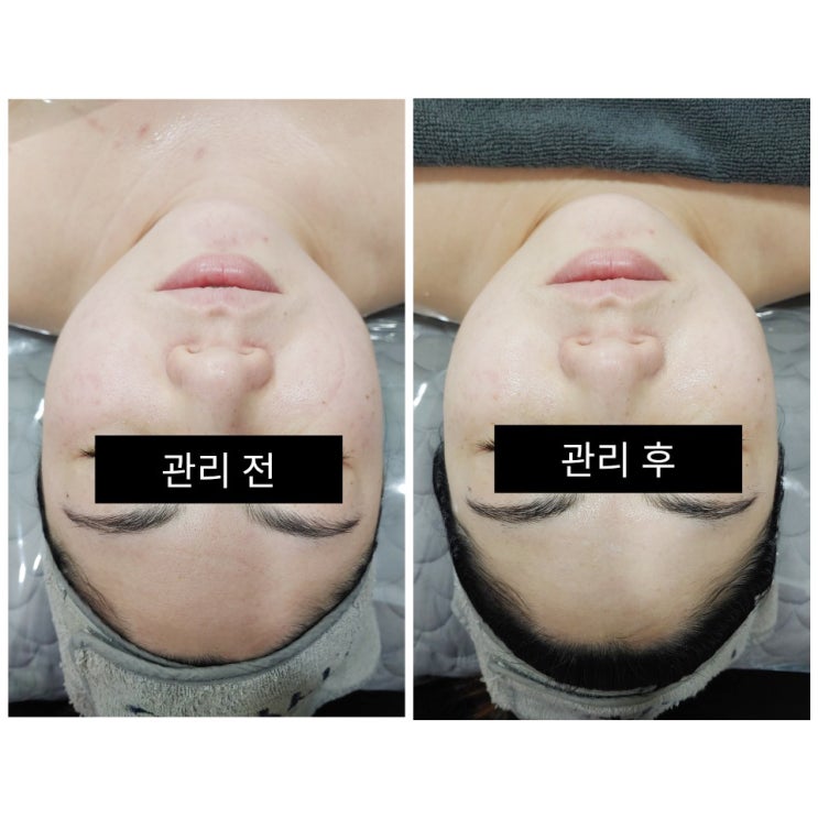  제주도 코로나 극복, 면역력강화 해독관리 가능한, 서귀포 피부관리샵! 도민할인Tip~