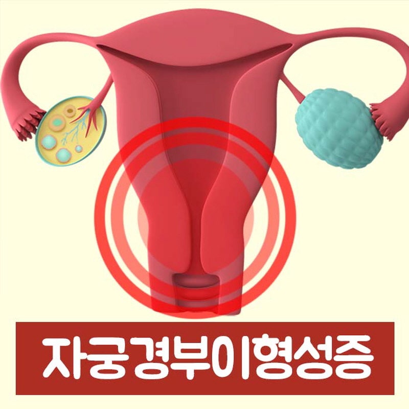 자궁경부이형성증의 원인과 증상, 자궁암의 전 단계라고? 6