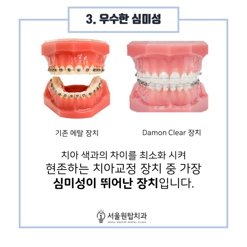 보다 투명해진 데몬 클리어 교정으로 심미성 UP
