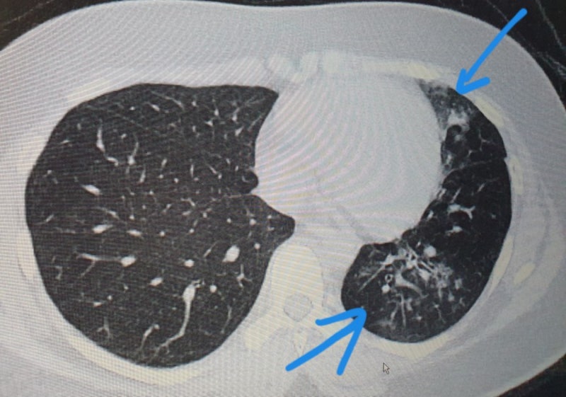 저선량 폐CT검사 폐렴초기진단과 폐암조기 검진 등 흉부질환 감별에 필수 : 네이버 블로그