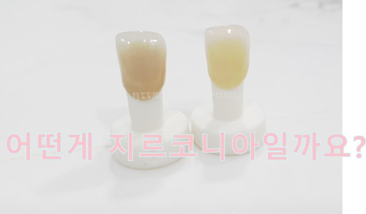  앞니보철종류*심미보철