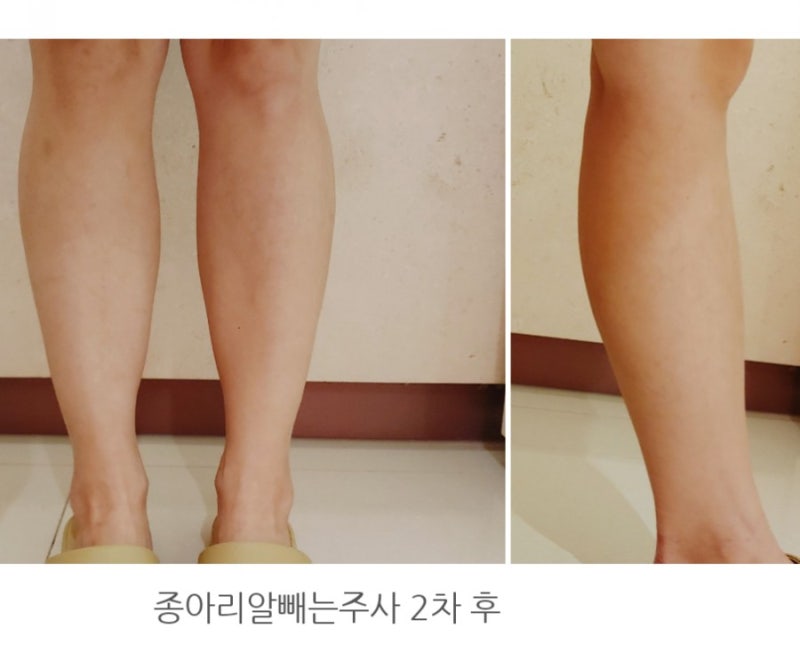 종아리 살빼기 어렵지 않았어요