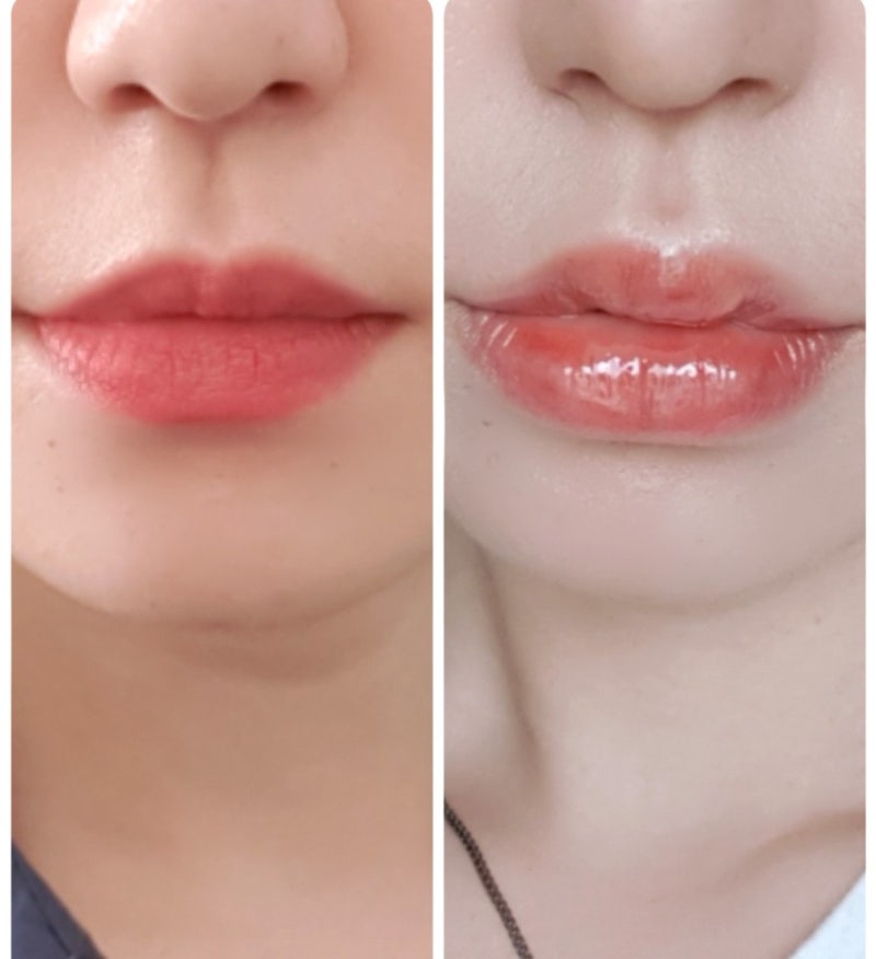 내동내산 구순구개열 입술 필러 입꼬리보톡스리뷰(포항,청주)