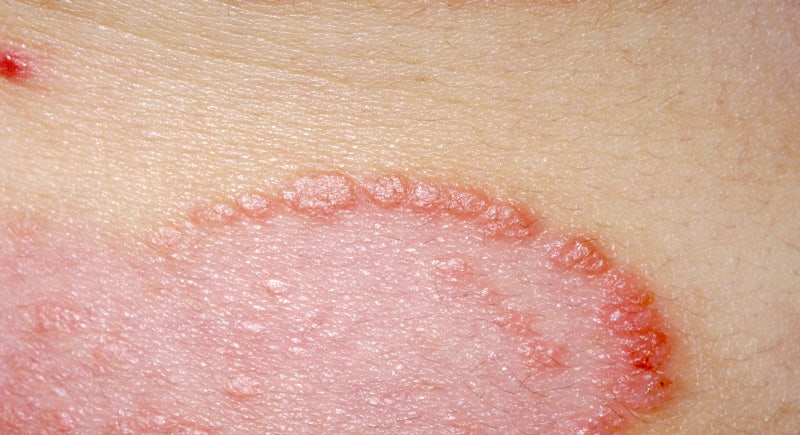 분당피부과 생소하지만 흔한 질환, 백선이란? 체부 백선의 원인과 증상, 그리고 치료법 : 네이버 블로그