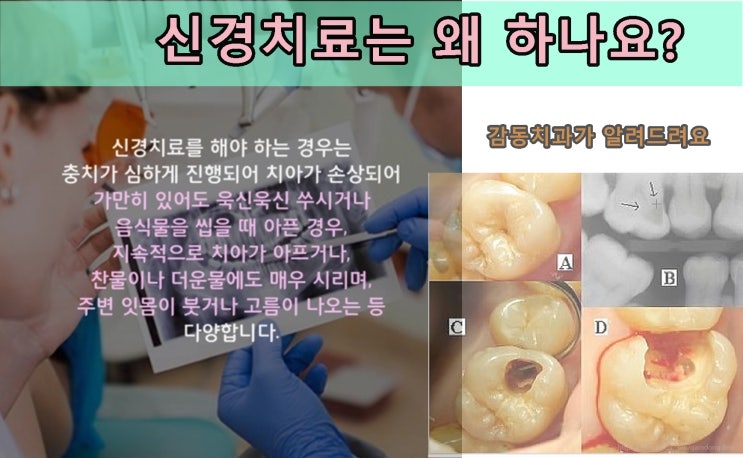  당감동신경치료잘하는감동치과