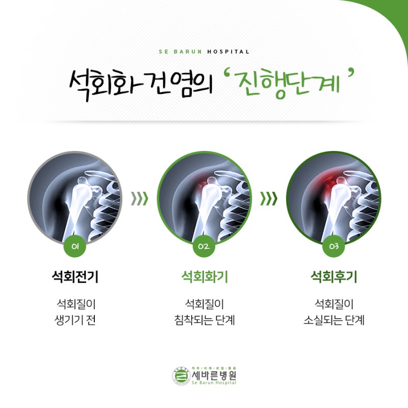 아차산 어깨 통증, 석회화 건염으로 인한 어깨 통증은 5