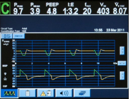  [벤틸레이터(ventilator) 기초]인공호흡기(ventilator) 기초, 용어, 작동, 해석 알려드립니다.