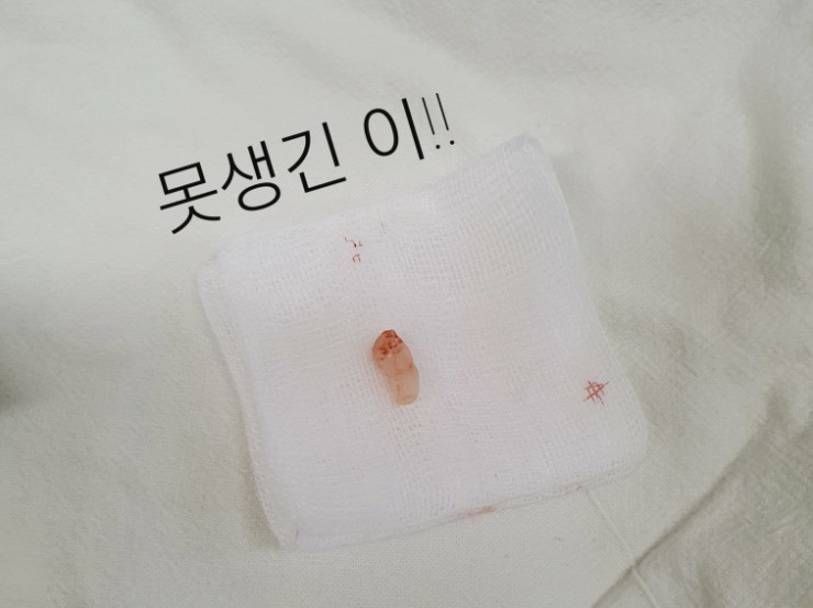 아산병원 과잉치 발치