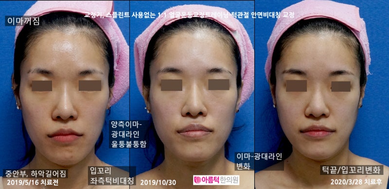 안면비대칭교정 - 얼굴형, 안면윤곽- 두개골 모양 모두 바꿔주는 턱관절 운동 : 네이버 블로그 안면비대칭교정 - 얼굴형, 안면윤곽- 두개골 모양 모두 바꿔주는 턱관절 운동 : 네이버 블로그