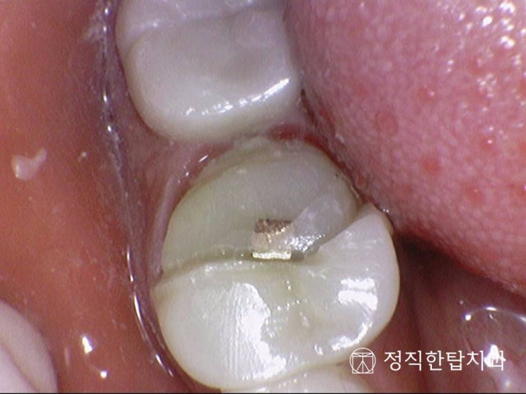  [정자 치과]크라운 제거 과정 보여드립니다. 오래된 보철 재치료