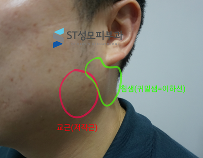  피부과전문의가 설명하는 침샘보톡스 효과 및 실제 증례 [사각턱 보톡스를 맞아도 얼굴이 넓어 보인다면 고려해보세요]