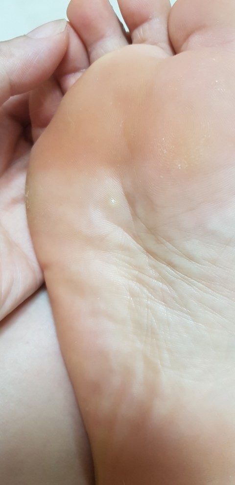  발바닥티눈제거 티눈밴드와 티눈약으로 발바닥티눈치료