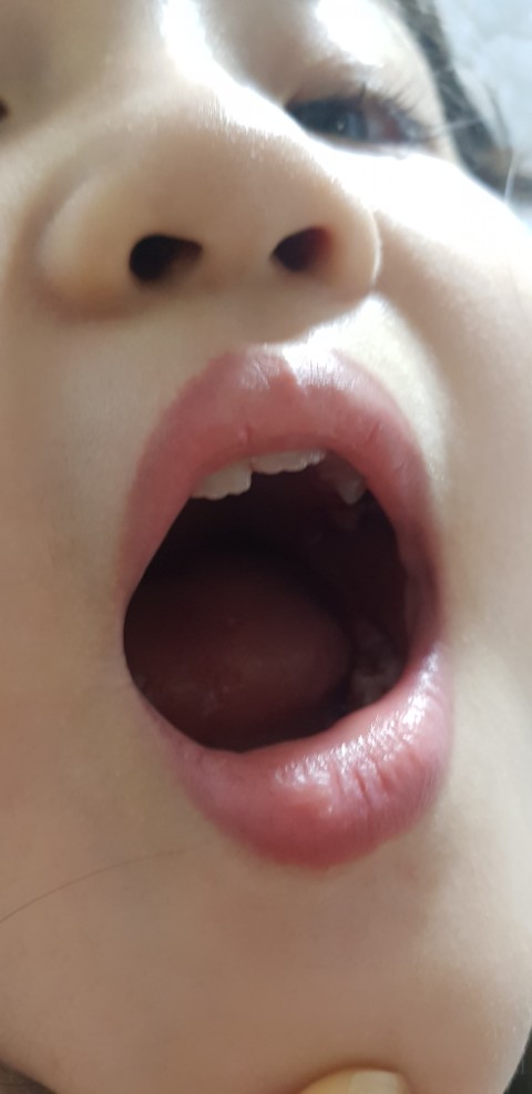  어금니가빠졌어요 어금니빠지는시기