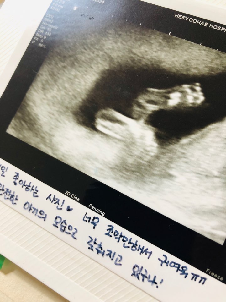  태아 딸꾹질 아무 문제 없는거죠