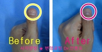  개인맞춤형 단지증 우렁손톱 교정 수술
