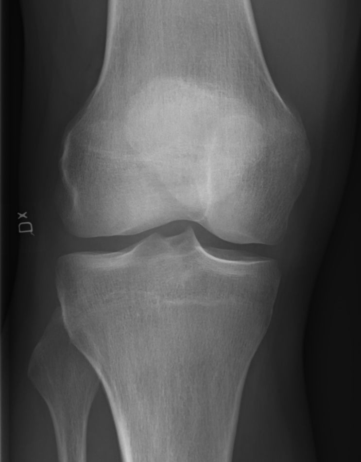 [질병정보] 무릎의 퇴행성 관절염 - 나이가 들면 무릎이 아픈 건 당연한걸까? (원인, 증상, 진단, 치료, 예방)