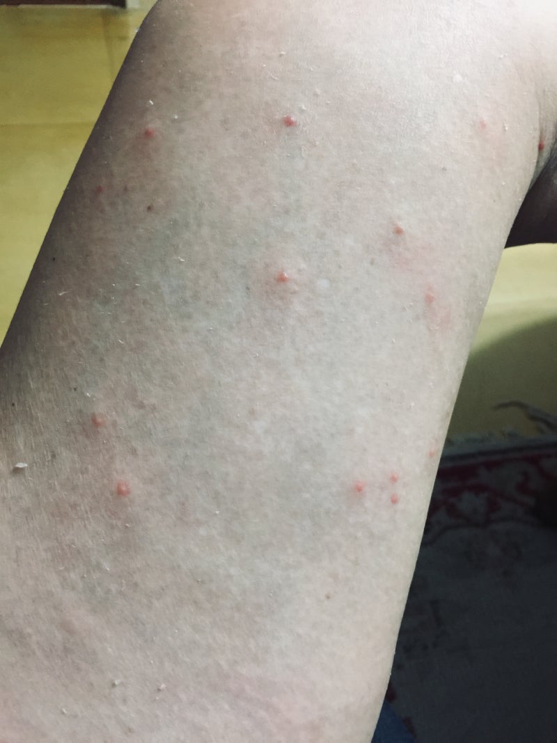 대상포진 .Vs. 진드기 .Vs. 옴 ? : 네이버 블로그