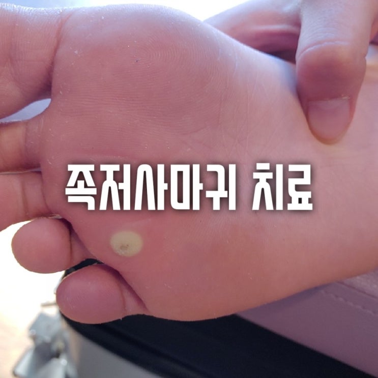  아이 발바닥에 티눈같은게 생겼어요!  족저사마귀 냉동치료 가격, 치료과정