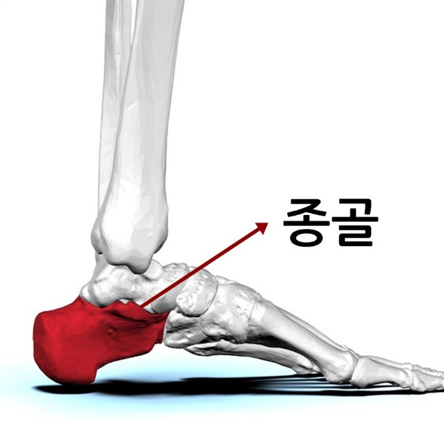  발바닥 통증(족저근막염) 원인 및 치료방법
