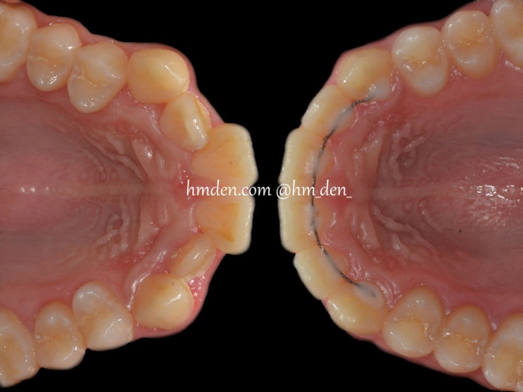 상악 치열 후방이동과 하악 전치 발치를 통한 돌출감 개선(최소 발치) 케이스 리뷰 - 미사교정치과