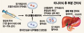 장기이식우선순위선정 세계해외사례: 공정한분배 장기기증비교 활성화해결방안