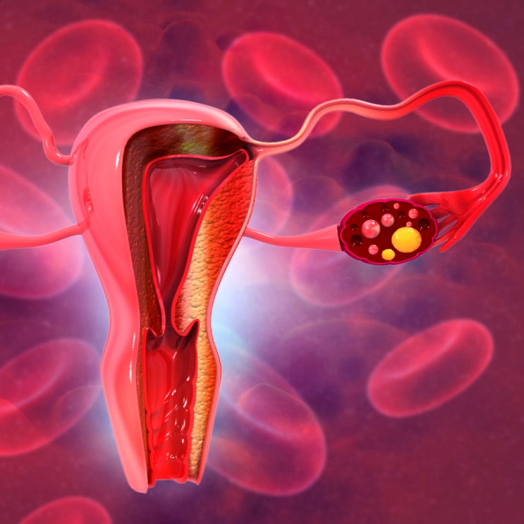 여성부정출혈 원인은 불임증이다?