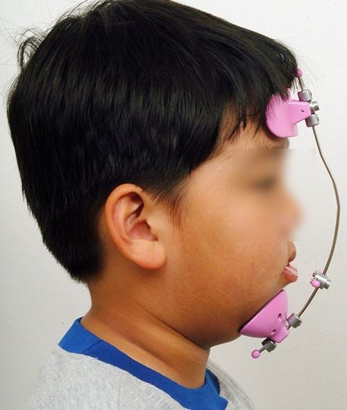 성장기 어린이의 소아교정이 필요한 경우 - 1. 반대교합턱교정시기, 장치, 부작용 총정리! 성장기 어린이의 소아교정이 필요한 경우 - 1. 반대교합턱교정시기, 장치, 부작용 총정리!