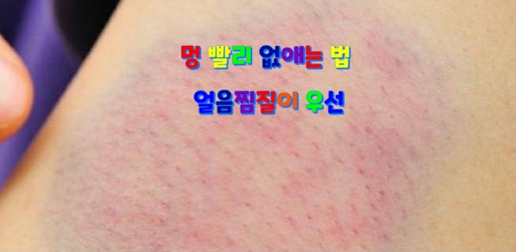 멍 빨리 없애는 법, 얼음찜질이 우선~ 멍 빨리 없애는 법, 얼음찜질이 우선~