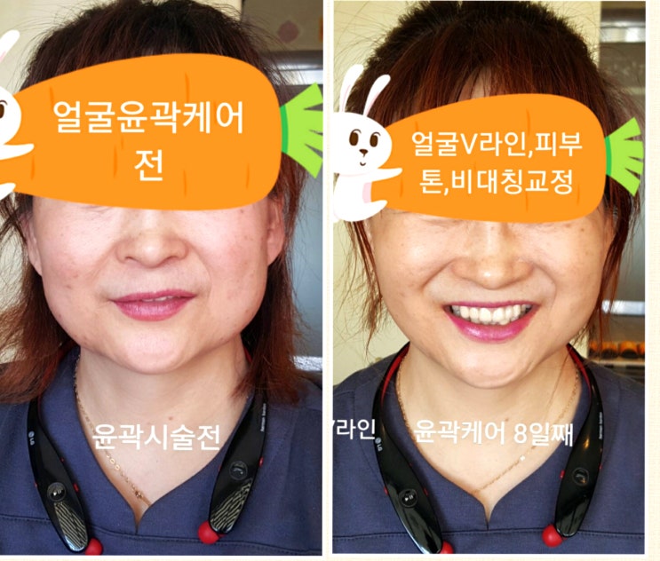  서귀포 팔자주름, 동안성형 피부관리&왁싱샵  도민 최대 50% 할인쿠폰 정보!