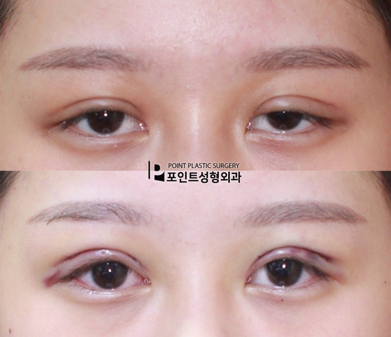 早期再手術の症例 1か月半目 医原性眼瞼下垂の再手術 네이버 블로그