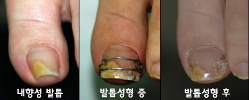  누가 발톱을 함부로 깍는가? - 살 파고드는 내향성 발톱 피하려면 발톱 일자로 반듯하게 자르세요.