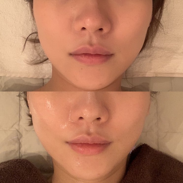 압구정 피부과 : 성형 붓기 : 코레지셀핏 리프팅 가격