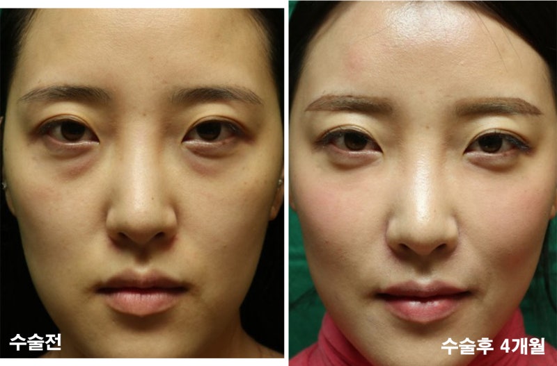 눈밑필러 부작용과 아르다의원 눈밑필러 시술
