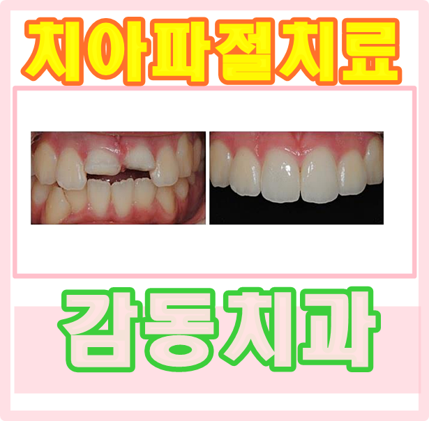  당감동 치아 파절치료는 감동치과에서 !!