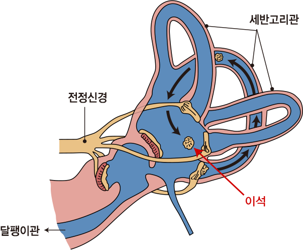 기사 스크랩) 부족한 비타민D 보충하면 이석증 예방 가능 기사 스크랩) 부족한 비타민D 보충하면 이석증 예방 가능