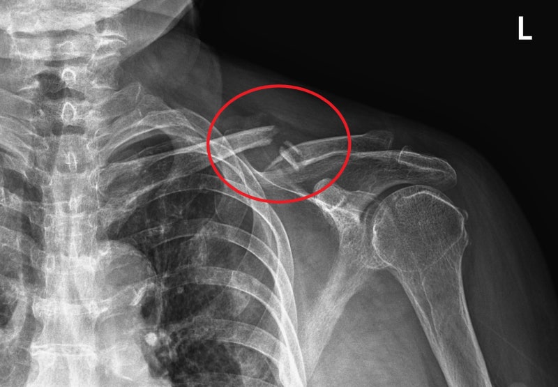 쇄골 골절, 빗장뼈 골절 치료 이야기 : 네이버 블로그
