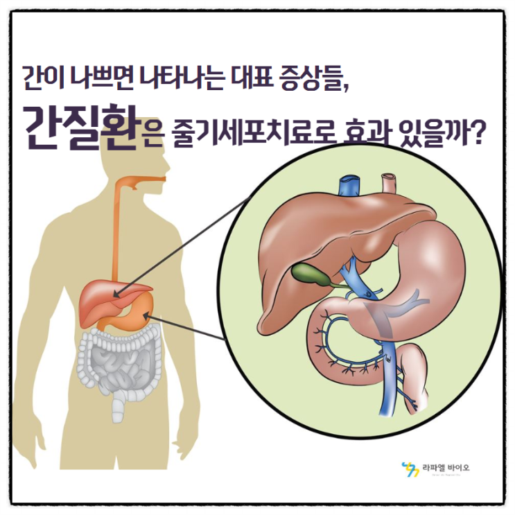 간이 나쁘면 나타나는 대표 증상들, 간질환은 줄기세포치료로 효과를 볼까?