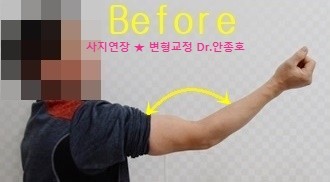  팔이 안구부러지고 안펴져요 - 팔꿈치 관절강직 수술