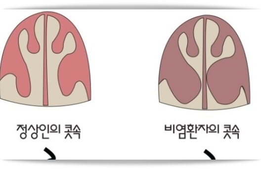 비염 증상 및 원인, 비염에 좋은 음식