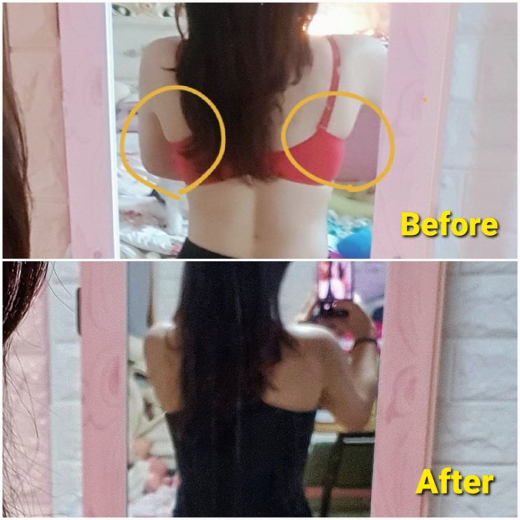  논현초 비만전문 피부과 바디인모드리프팅 지방분해까지 한번에!