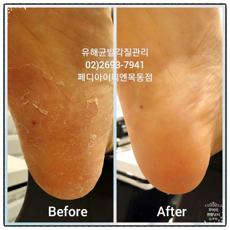  양천구 신정동 내성발톱, 발톱무좀, 발각질 꼼꼼한 네일샵 정착!