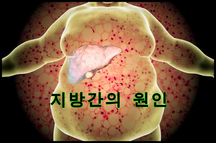  지방간이 술 담배도 안하고 마른 사람도 생기는 이유?