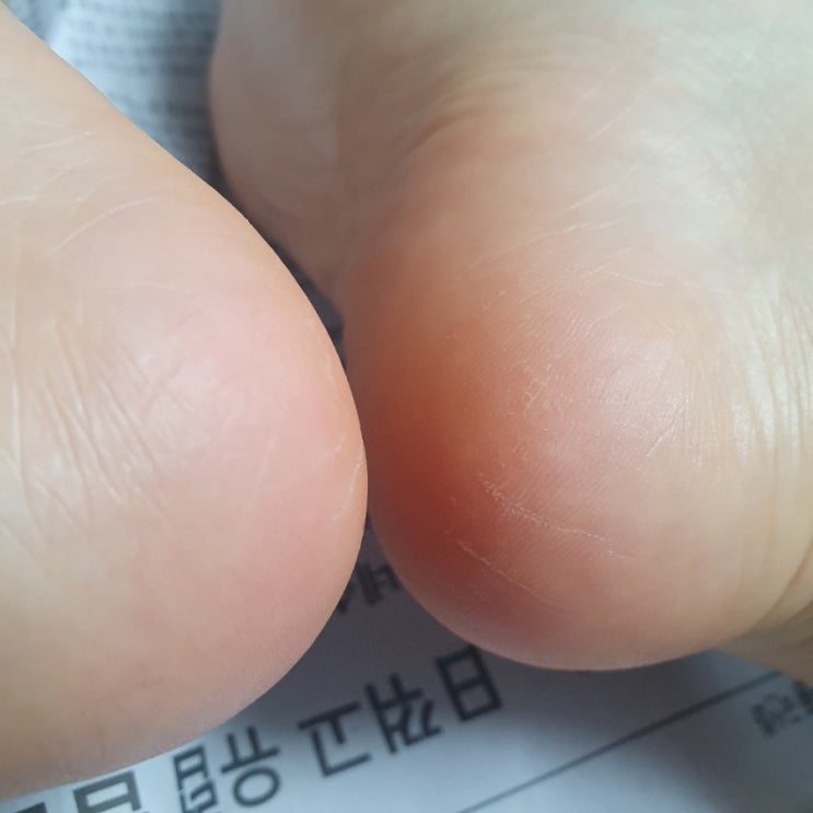  겨울철 발 각질제거제 키트 후기
