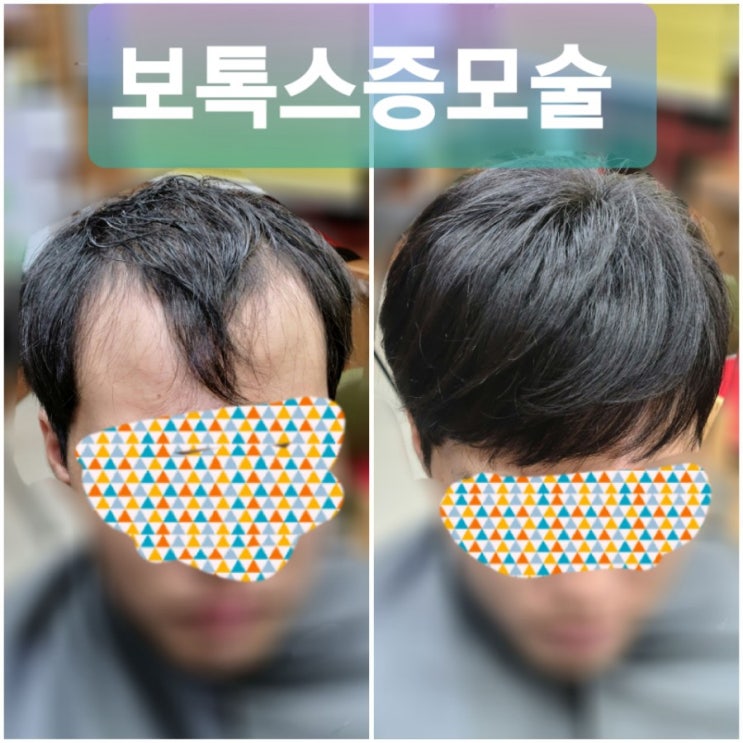  m자이마 탈모도 서러운데 정수리 탈모까지 ㅠ 보톡스증모술에 맡겨보세요~