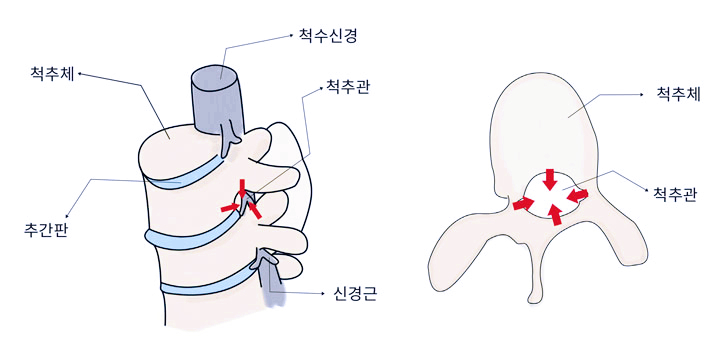  척추관 협착증 증상과 치료 및 예방 , 협착증에 좋은 음식 7가지