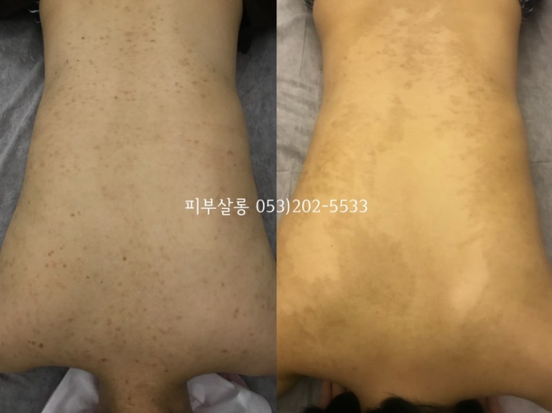 대구피부관리실)달서구 알라딘필링팔여드름자국재생케어리뷰/죽전동피부관리실 12