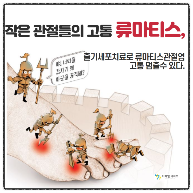  작은 관절들의 고통 류마티스, 줄기세포치료로 류마티스관절염 고통을 멈출 수 있다.