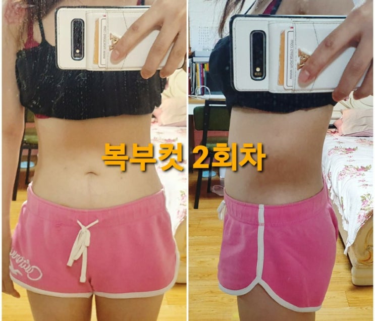  아랫배빼기 컷주사 2회차 (붓기,둘레,멍,비교)
